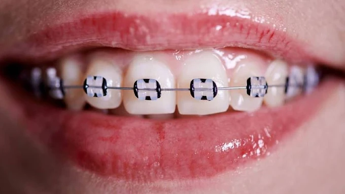 Uso Brackets | Ortodoncia y Estética Dental para Niños, Jóvenes y Adultos