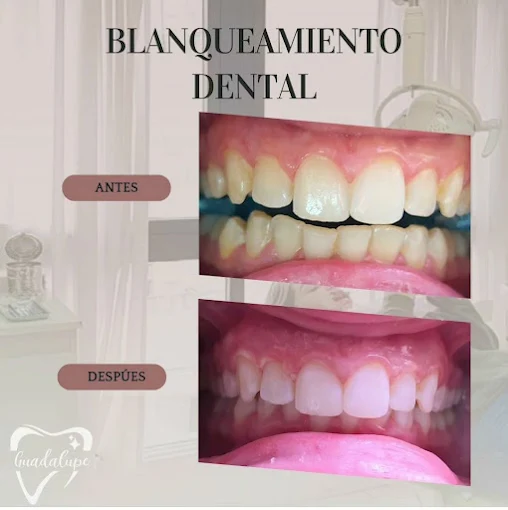 Odontología Guadalupe | Implantes, Blanqueamientos y Bótox para Bruxismo